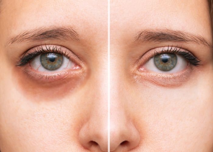how to get rid of dark circles under eyes healthbeautybee
