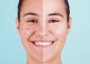 how to get rid of pimples and acne overnight