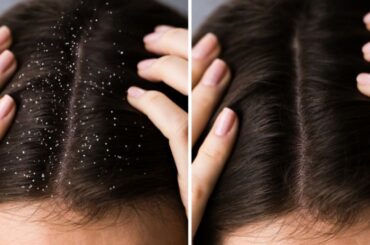 how to get rid of dandruff