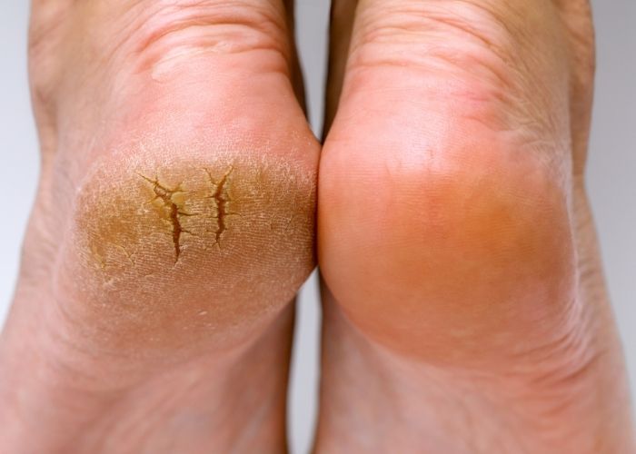 how to heal cracked feet overnight