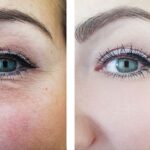 how to get rid of wrinkles under eyes