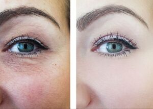 how to get rid of wrinkles under eyes