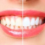 how to get white teeth healthbeautybee