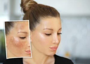 how to remove dark spots on face fast