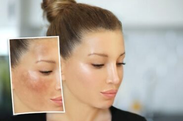 how to remove dark spots on face fast