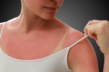 sun tan removal remedies healthbeautybee