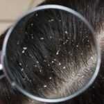 Hair Masks for Dandruff-Free Hair healthbeautybee