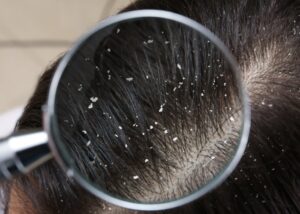 Hair Masks for Dandruff-Free Hair healthbeautybee