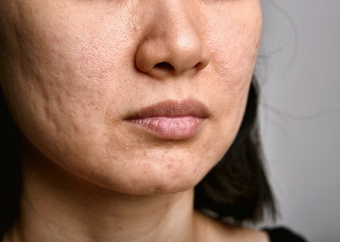 How to Treat Open Pores on Face healthbeautybee
